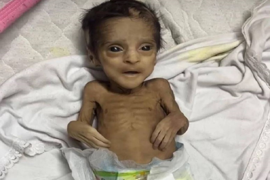 تحذير فلسطيني واسع من تسارع وتيرة تفشِّي المجاعة في غزة 