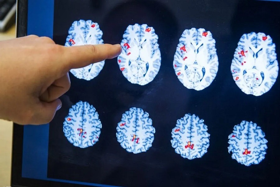 الحالة العقلية للأميركيين ليست على ما يرام.. ارتفاع مقلق في الإعاقات الإدراكية