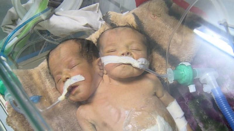 وزارة الصحة اليمنية: وفاة الطفلين الملتصقين جراء الحصار ورفض فتح مطار صنعاء