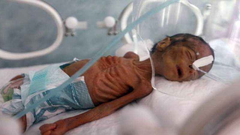 وزارة الصحة اليمنية تدعو أحرار العالم إلى التحرك لرفع الحصار