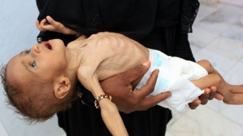مليونان و740 ألف طفل يعانون من سوء تغذية حاد في اليمن